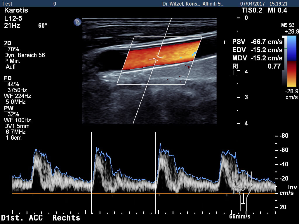 Farbdoppler-Bild einer Halsschlagader | Dr. Achim Witzel
